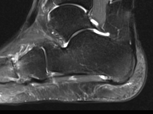 Plantar fasciitis MRI